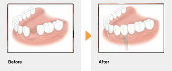1本のインプラント