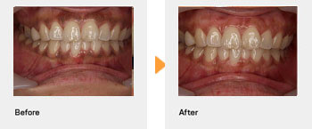 ガムピーリング